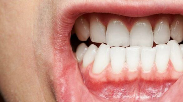 Types of Gum Disease