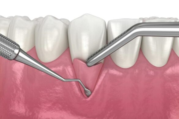 Can you Heal Receding Gums Without Surgery?