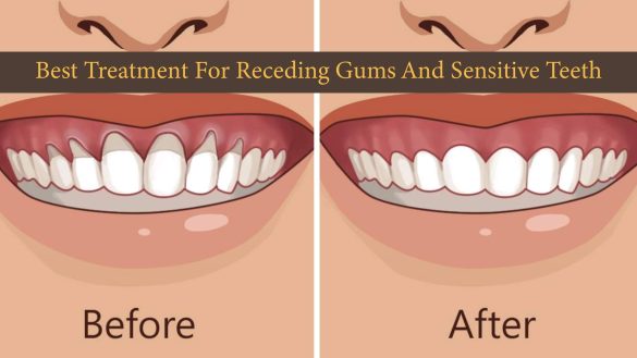 Treatment For Receding Gums