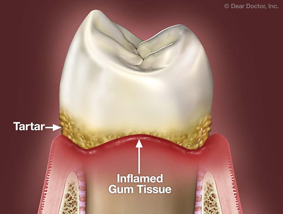 receding gums