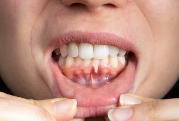 Symptoms Of Loose Teeth And Receding Gums