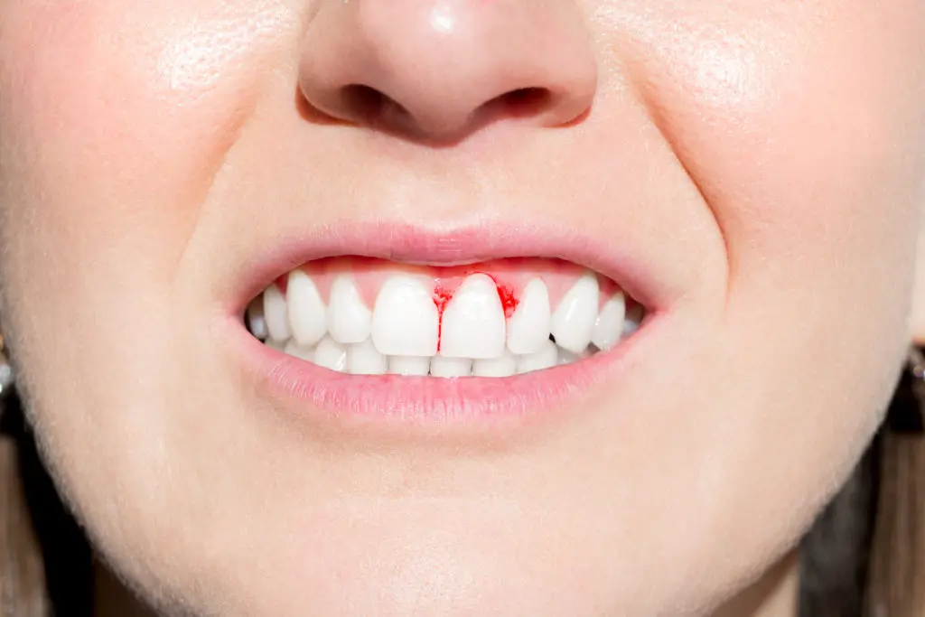 home remedies for bleeding gums