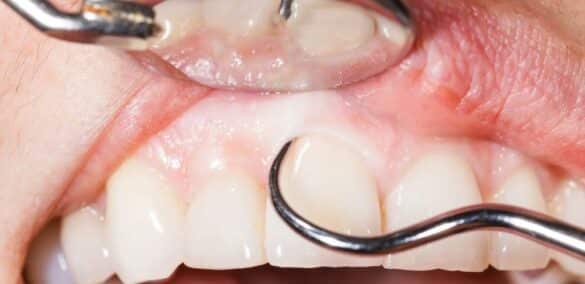 Can Receding Gums Fix Themselves? Myths and Realities Explained