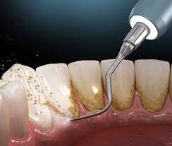 Treatment For Receding Gums