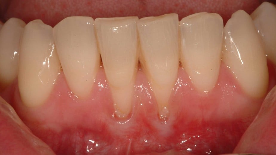 Treatment For Receding Gums