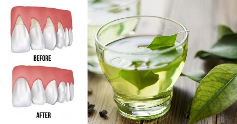 home remedies for bleeding gums