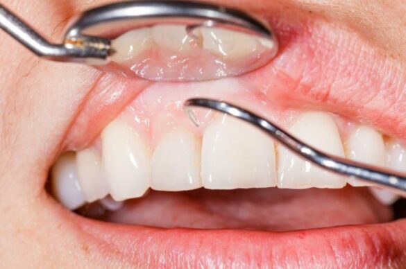 Prevent Receding Gums from Getting Worse: Essential Tips