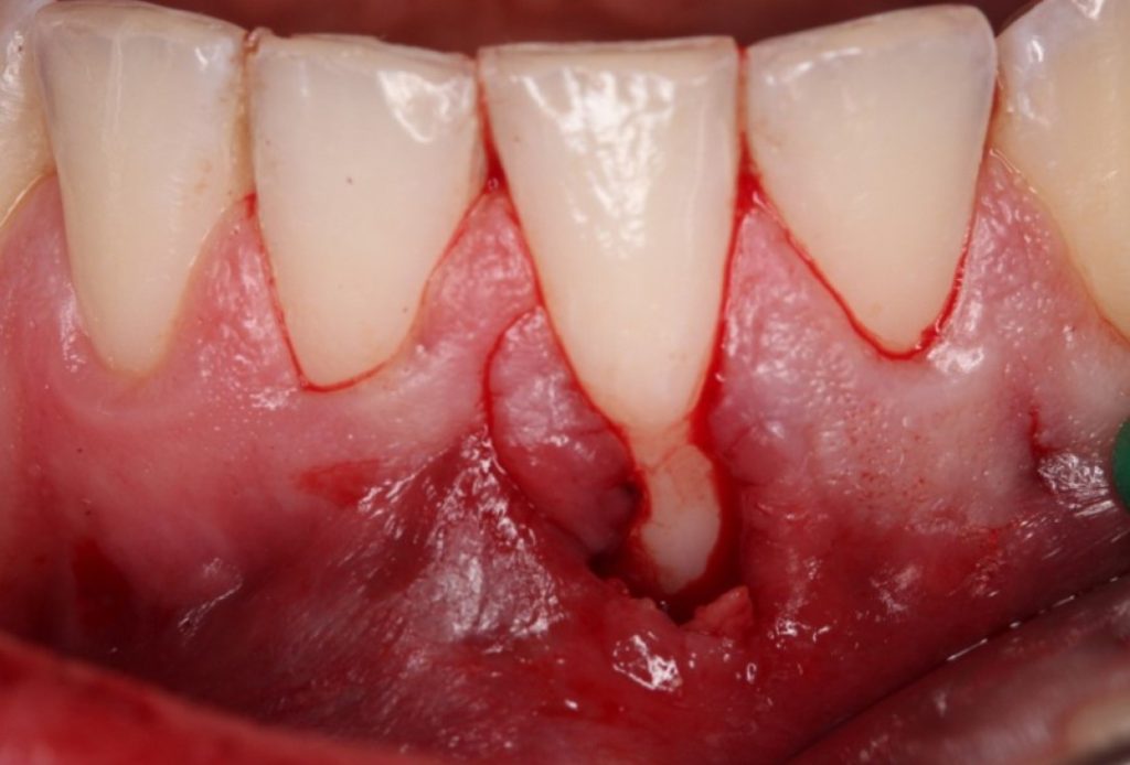 Treatment For Receding Gums