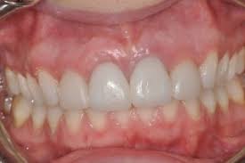 Treatment For Receding Gums