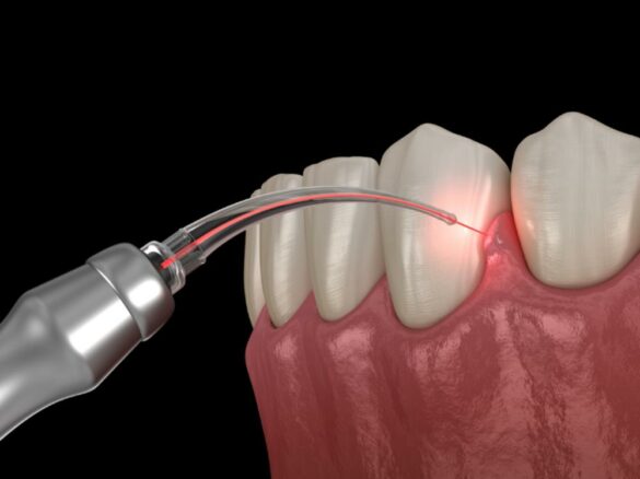 Receding Gums Treatment Options: Gum Graft Surgery