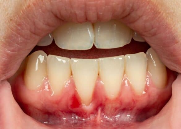 Shrinking Gums: The Effects Of Teeth Grinding On Oral Health