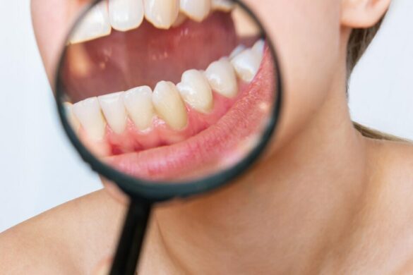 Visible gum recession