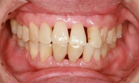 Receding Gums Severity: Causes, Prevention & Treatment